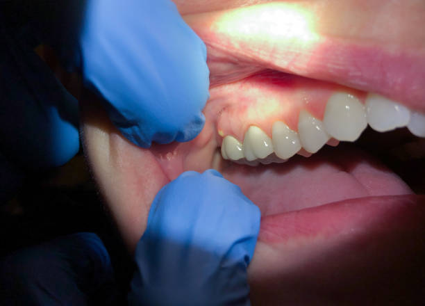 Best Broken or Chipped Tooth Repair in Village Of Four Seasons, MO
